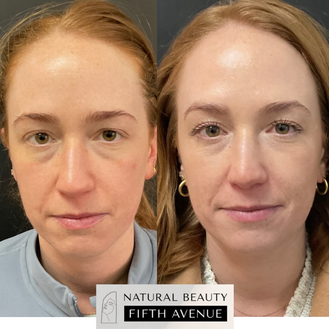 Before and after Botox injections showing reduced forehead lines and smoother skin texture